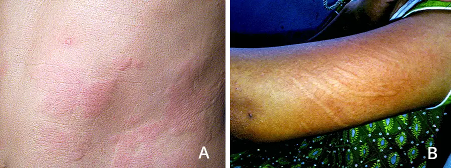 Chronic hives demands long-term care, not endless trigger searches: experts - 4
