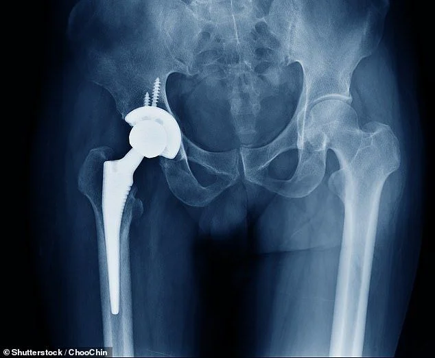 Almost a MILLION people will have knee and hip replacements cancelled... as interactive map reveals areas where waiting lists will soar - 1