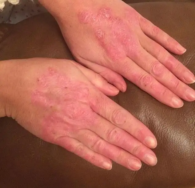 I was tortured by psoriasis for 20 years. Then I finally found a simple cure that really works - and it saw me lose 3 stone too WITHOUT medication. Everyone plagued by itchy red skin patches should make these easy lifestyle tweaks - 1