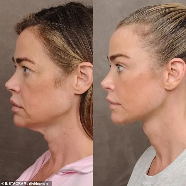 Denise Richards's plastic surgeon reveals stunning before-and-after photos of her facelift - 1