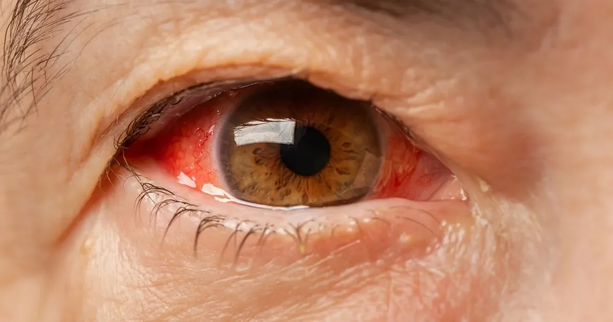 The signs a blemish or freckle in your eye has turned cancerous like Emily's. Cases have soared a shocking 30 per cent. Now doctors reveal the warning signs everyone must know - 4