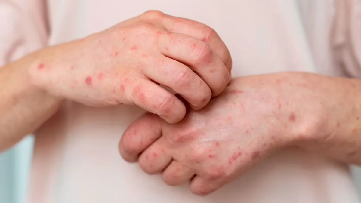 Survey shows older adults with chronic health conditions are hit hard by shingles - The Hindu - 3