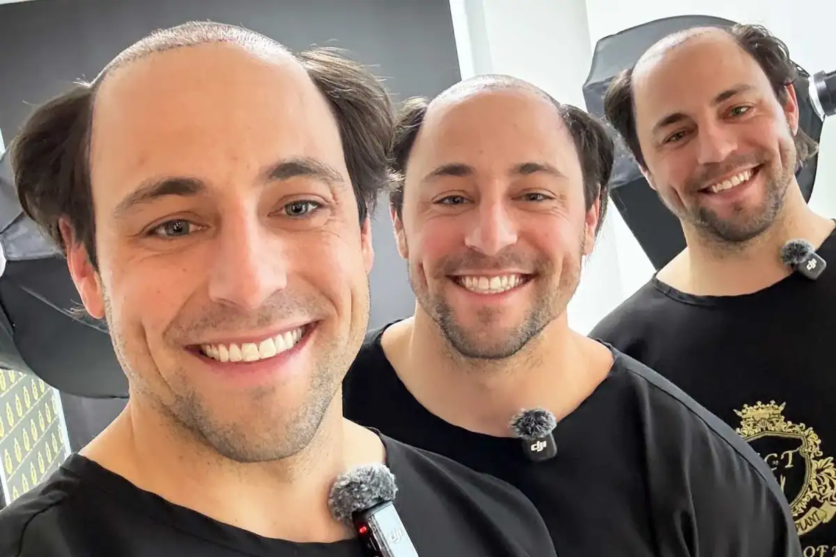 Triplets paid $13,000 each for hair transplants. It gave them new confidence in their jobs. - 4