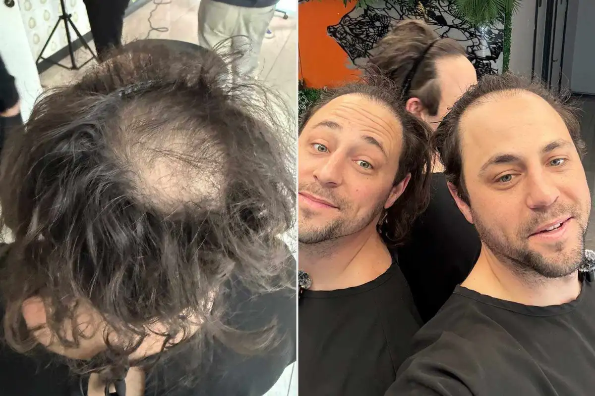 Brothers both find love after undergoing matching hair transplants - 2