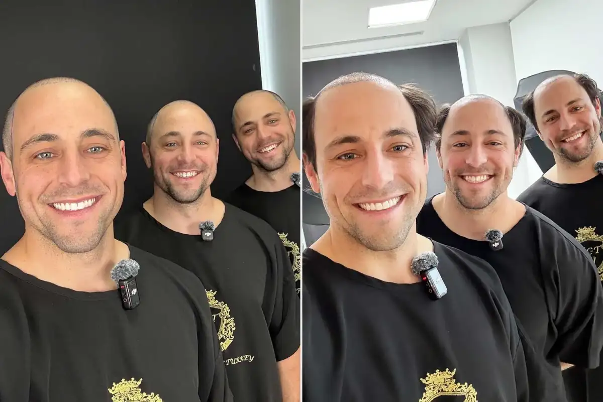 Brothers both find love after undergoing matching hair transplants - 3
