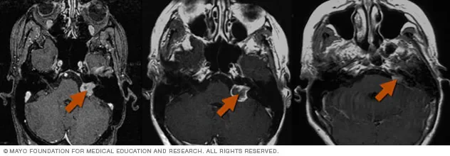 5 million patients worldwide need radiosurgery for brain tumour yearly; less fewer than 10% receive it: John R. Adler - 4