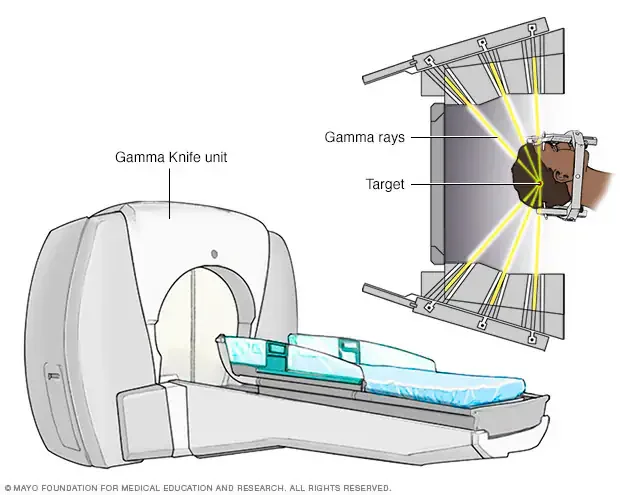 5 million patients worldwide need radiosurgery for brain tumour yearly; less fewer than 10% receive it: John R. Adler - 1