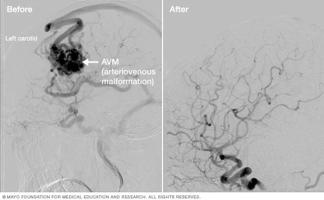 5 million patients worldwide need radiosurgery for brain tumour yearly; less fewer than 10% receive it: John R. Adler - 2