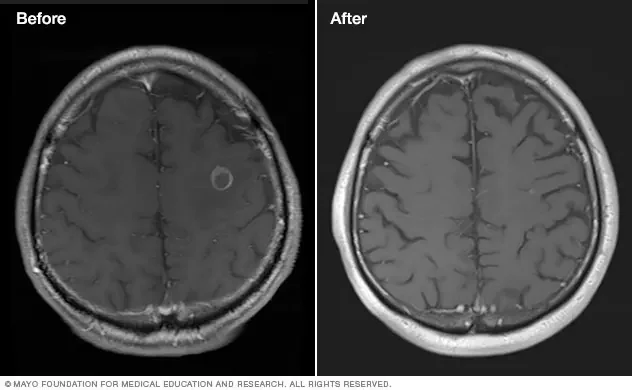 5 million patients worldwide need radiosurgery for brain tumour yearly; less fewer than 10% receive it: John R. Adler - 3